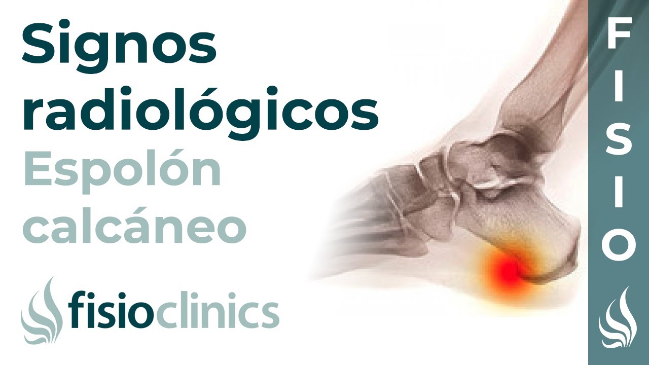 Spolon Radiography ֍ Espolón calcáneo: Signos radiológicos ⚕️ Clínica Estemedic